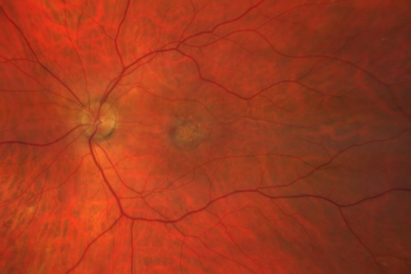 AMD Fundus Photography
