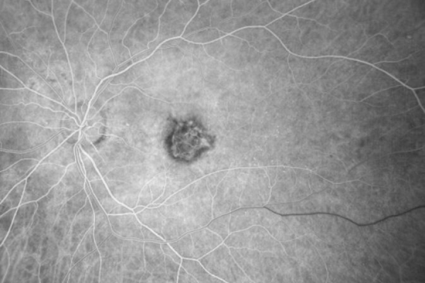 Ocular image of early FA